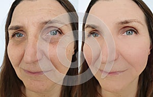 Woman  wrinkles before  after sagging  treatment pigmentation
