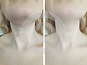 Woman wrinkles before and after saggy treatment photo