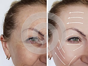 Woman wrinkles skin antiaging collagen before and after regeneration