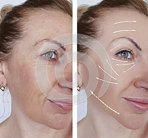 Woman wrinkles skin difference antiaging contours before and after regeneration