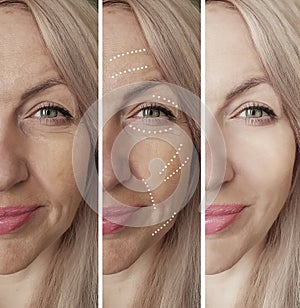 Woman wrinkles skin face lift difference cosmetology before and after treatments