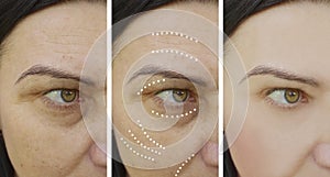 Woman wrinkles skin face lift rejuvenation therapy difference cosmetology before and after treatments