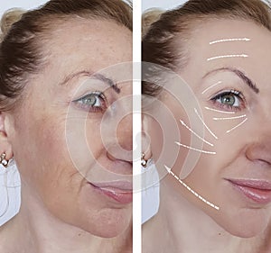 Woman wrinkles skin difference antiaging contours before and after regeneration photo