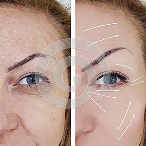 Woman wrinkles skin treatment before and after dermatology procedures regeneration