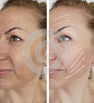 Woman wrinkles skin treatment difference antiaging contours before and after regeneration