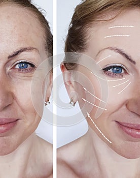 Woman wrinkles skin treatment difference contours before and after regeneration