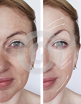 Woman wrinkles skin treatment difference before and after regeneration