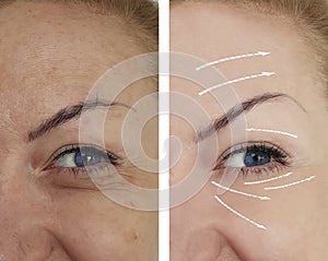 Woman wrinkles skin treatment before and after regeneration