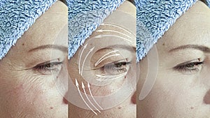 Woman wrinkles skin  after plastic  facial  collagen effect lifting procedure treatment, thread lifting