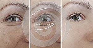 Woman wrinkles  swollen removal  lifting  regener blepharoplasty   therapy contrast before treatment difference sagging correction