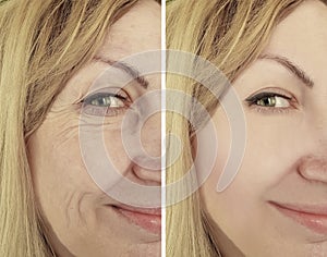 Woman wrinkles before and after therapy, ageing procedure biorevitalization treatments