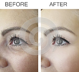 Woman wrinkles before and after treatment treatment  anti, aging  procedures