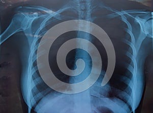 Woman xray for chest and lungs examination