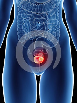 A womans bladder cancer photo