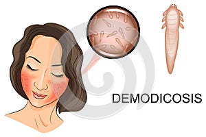 The womans face affected by demodicosis