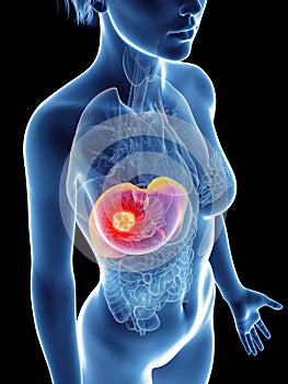 a womans liver cancer