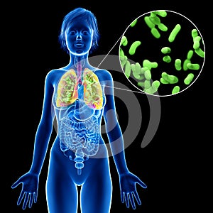 A womans lung infection