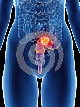 A womans rectum cancer photo