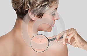 On the womanâ€™s back, the doctor examines a problem skin area with a magnifying glass