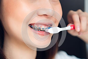 Women are brushing teeth that wear braces, in a toilet. Must maintain good oral health.