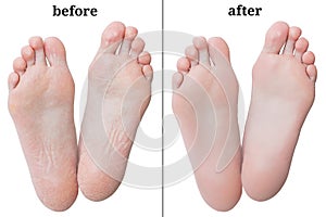 Women feet before and after peeling.