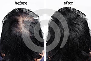 Women hair after using cosmetic powder for thickening. Before and after