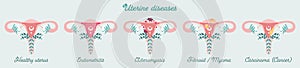 Women health - infographics. Uterus diseases - Anatomical schemes. Gynecological diseases - adenomyosis, fibroid e.t.c. photo