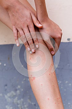 Women with his feet, itching on the lawn caused by insect bites and stings health and medical view and devising concepts