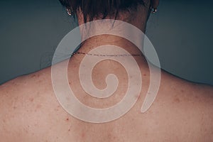 Women posing next to the old black textured wall. slender body of a teenager, covered with moles and pimples. problematic skin bac