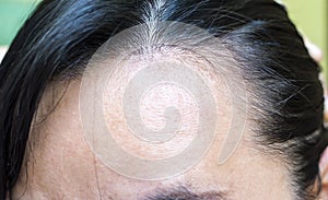 Women`s hair loss problem.It`s serious problem  of women