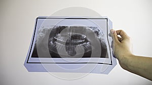 Women`s hands holding x-ray teeth scan. Upper teeth with dental brace