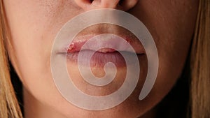 Women`s lip ulcers herpes closeup. Beautiful lips were covered with cold sores. The girl licks her lips covered with