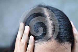 Women with thin hair caused by hair loss symptoms