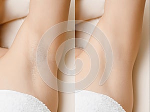 Women underarm hair removal before and after photo