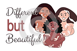 Women with vitiligo Different but beautiful vector illustration