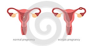 womens health normal and ectopic pregnancy embryo photo