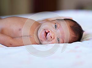 She wont let her birth defect get her down. Portrait of a baby girl with a cleft palate lying on a bed.