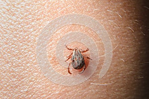 Forest mite on the skin. wood tick