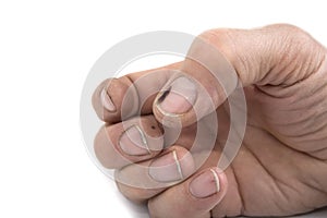 Worker dirty bruised hands and nails on a white background