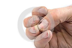 Worker dirty bruised hands and nails on a white background