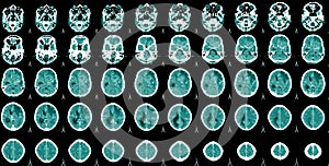 World Stroke Day,CT Scan Brain A man suffering from pulsating pain of headache. People medical healthcare and technology  concept