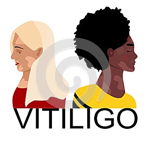 World vitiligo day.Young women different ethnicities with skin disease. Depigmentation problem.