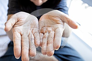 Worried asian woman showing a lot of fallen hair in her hands,hair loss problem or female patient suffering from alopecia disease