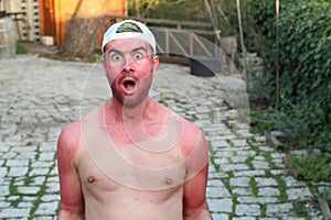 Worried sunburned man with skin irritation