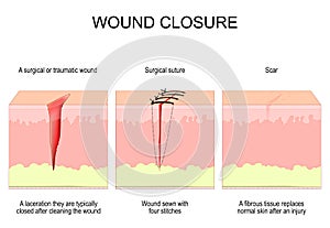 Wound closure. From surgical or traumatic wound to suture and scar