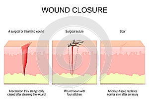Wound closure. From surgical or traumatic wound to suture and scar photo