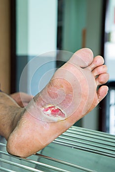 Wound of diabetic foot