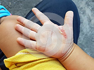 Wound in the hand of a child from an iron burn.