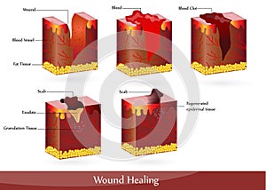 Wound healing