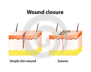 Wound healing process with help surgical suture.